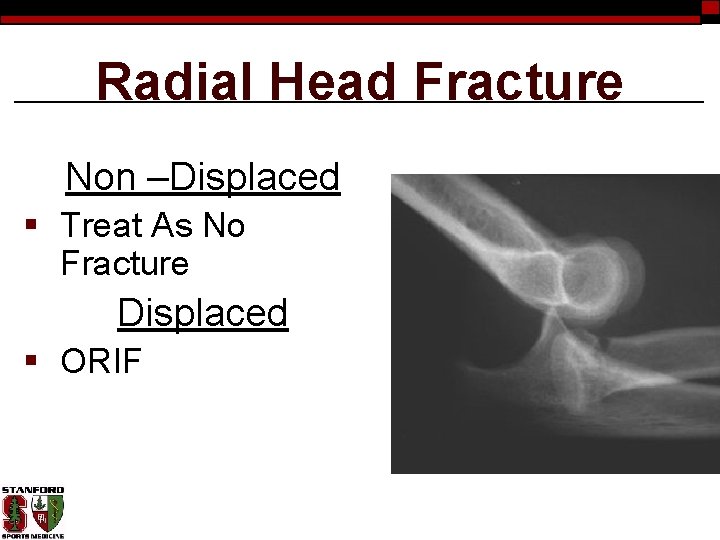 Radial Head Fracture Non –Displaced § Treat As No Fracture Displaced § ORIF 