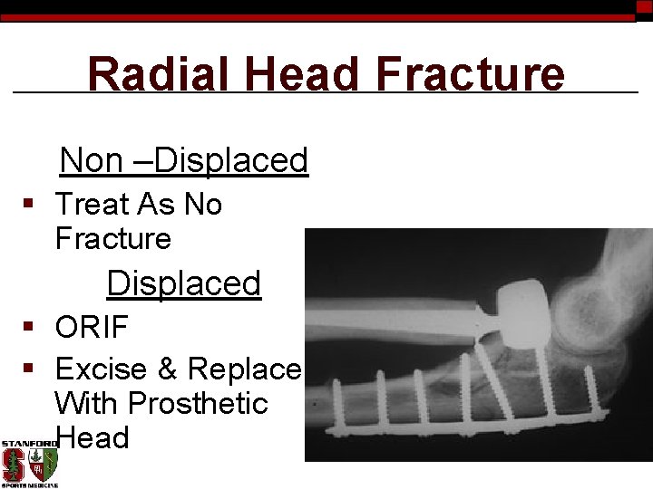 Radial Head Fracture Non –Displaced § Treat As No Fracture Displaced § ORIF §