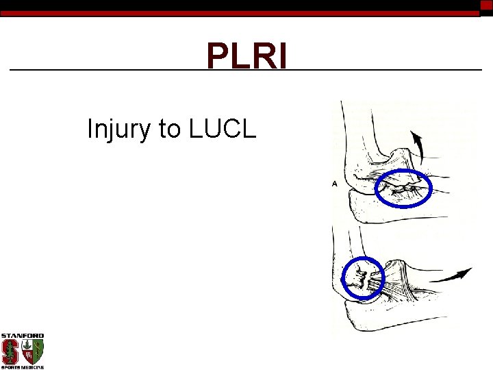 PLRI Injury to LUCL 
