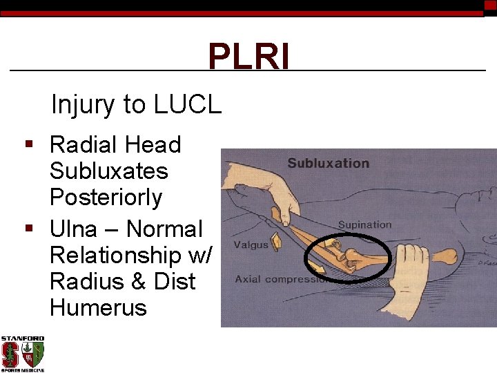 PLRI Injury to LUCL § Radial Head Subluxates Posteriorly § Ulna – Normal Relationship