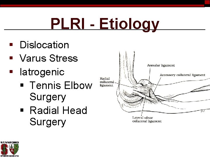 PLRI - Etiology § Dislocation § Varus Stress § Iatrogenic § Tennis Elbow Surgery