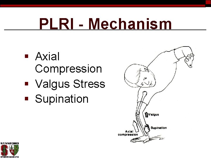 PLRI - Mechanism § Axial Compression § Valgus Stress § Supination 