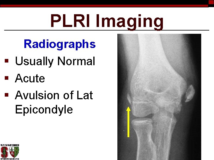 PLRI Imaging Radiographs § Usually Normal § Acute § Avulsion of Lat Epicondyle 