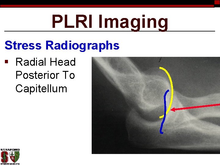 PLRI Imaging Stress Radiographs § Radial Head Posterior To Capitellum 