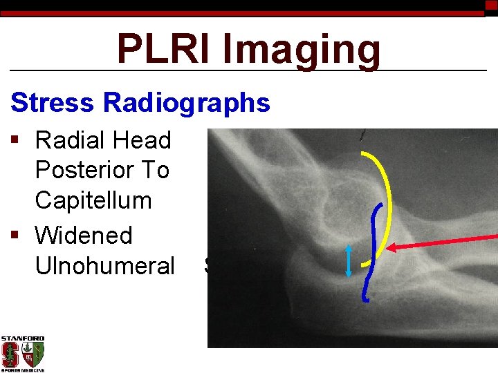 PLRI Imaging Stress Radiographs § Radial Head Posterior To Capitellum § Widened Ulnohumeral Space