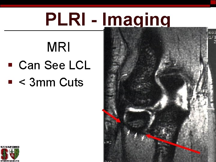 PLRI - Imaging MRI § Can See LCL § < 3 mm Cuts 