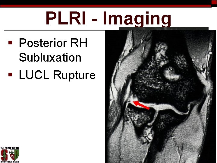 PLRI - Imaging § Posterior RH Subluxation § LUCL Rupture 