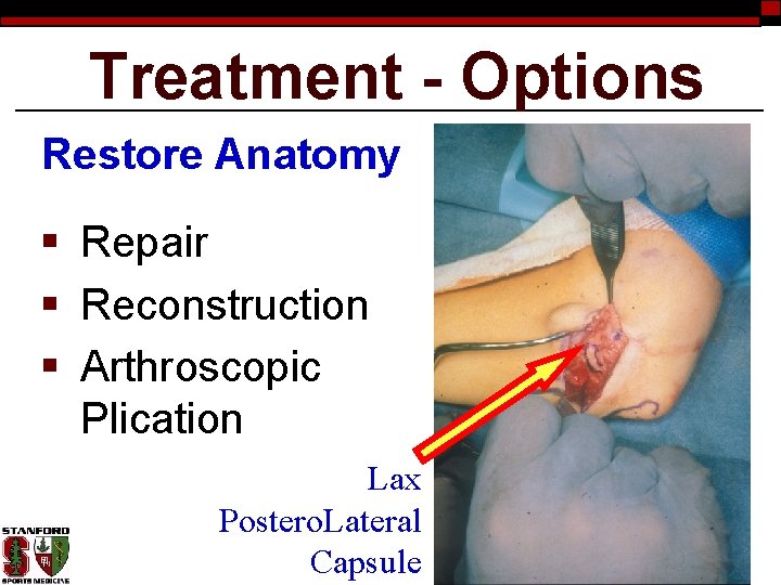 Treatment - Options Restore Anatomy § Repair § Reconstruction § Arthroscopic Plication Lax Postero.