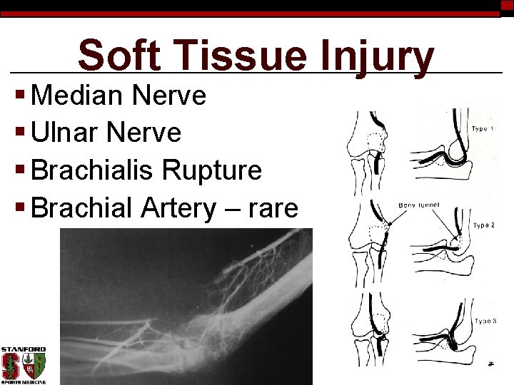 Soft Tissue Injury § Median Nerve § Ulnar Nerve § Brachialis Rupture § Brachial