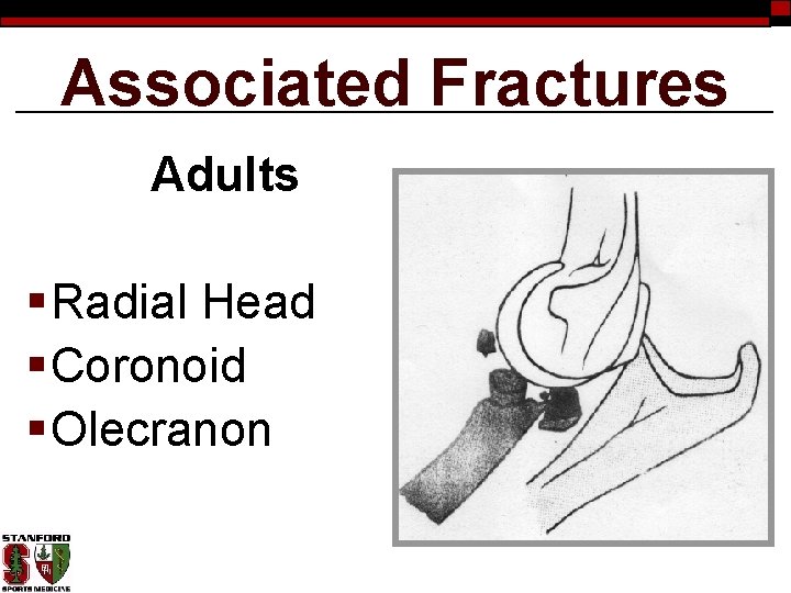 Associated Fractures Adults § Radial Head § Coronoid § Olecranon 