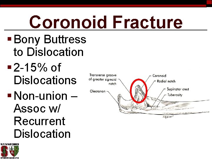 Coronoid Fracture § Bony Buttress to Dislocation § 2 -15% of Dislocations § Non-union