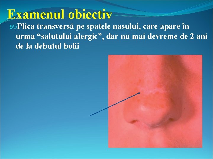 Examenul obiectiv Plica transversă pe spatele nasului, care apare în urma “salutului alergic”, dar