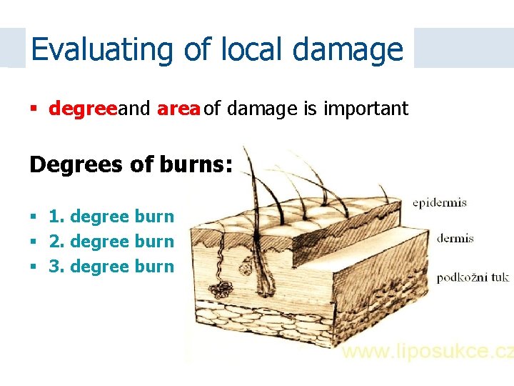 Evaluating of local damage degreeand area of damage is important Degrees of burns: 1.