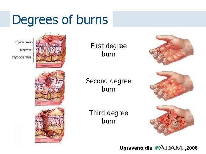 Degrees of burns First degree burn Second degree burn Third degree burn Upraveno dle