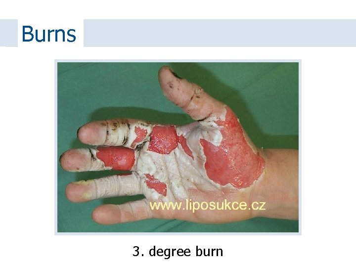 Burns 3. degree burn 