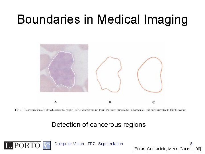 Boundaries in Medical Imaging Detection of cancerous regions Computer Vision - TP 7 - Boundaries in Medical Imaging Detection of cancerous regions Computer Vision - TP 7 -
