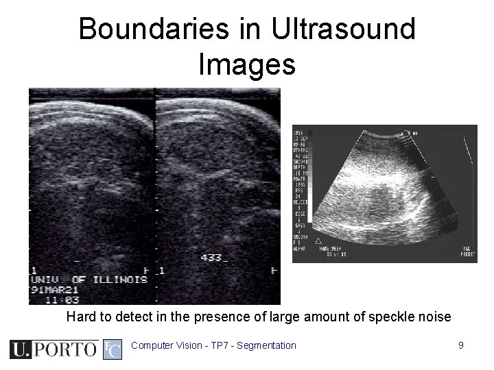 Boundaries in Ultrasound Images Hard to detect in the presence of large amount of Boundaries in Ultrasound Images Hard to detect in the presence of large amount of