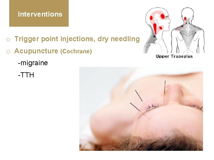 Interventions o Trigger point injections, dry needling o Acupuncture (Cochrane) -migraine -TTH 