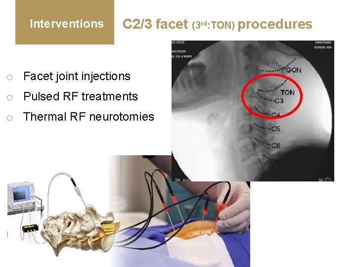 Interventions C 2/3 facet (3 rd: TON) procedures o Facet joint injections o Pulsed