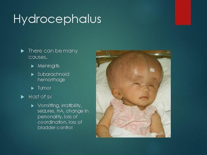 Hydrocephalus There can be many causes. Meningitis Subarachnoid hemorrhage Tumor Host of sx Vomitting,