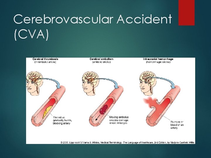 Cerebrovascular Accident (CVA) 