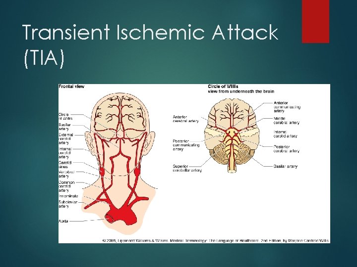Transient Ischemic Attack (TIA) 