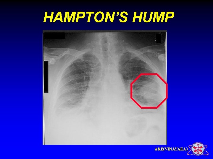 HAMPTON’S HUMP A&E(VINAYAKA) 