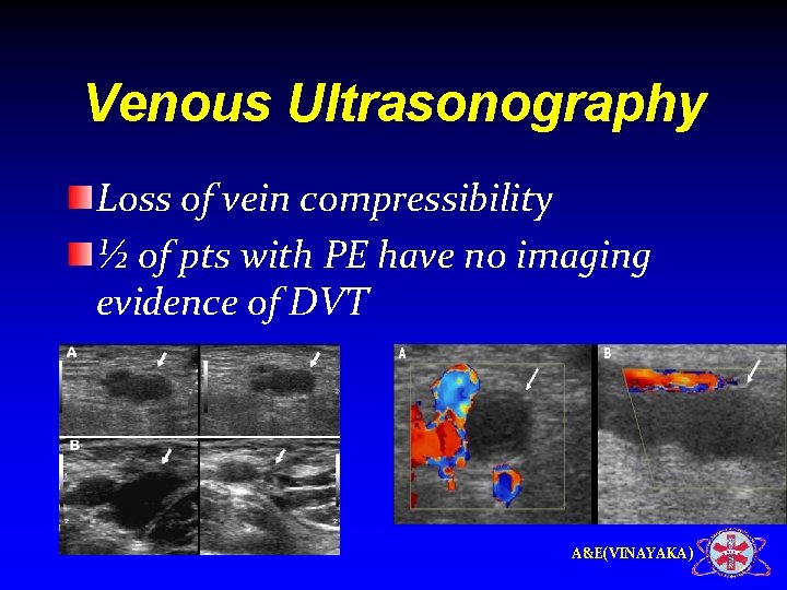 Venous Ultrasonography Loss of vein compressibility ½ of pts with PE have no imaging