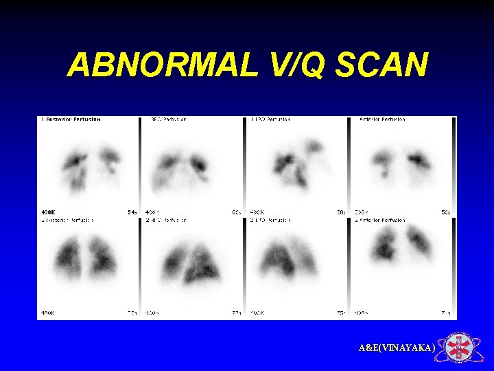 ABNORMAL V/Q SCAN A&E(VINAYAKA) 