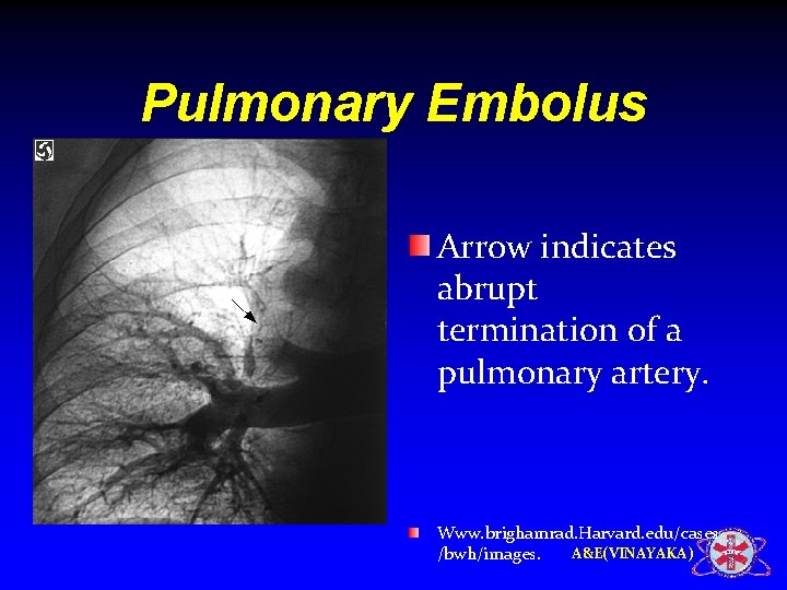 Pulmonary Embolus Arrow indicates abrupt termination of a pulmonary artery. Www. brighamrad. Harvard. edu/cases