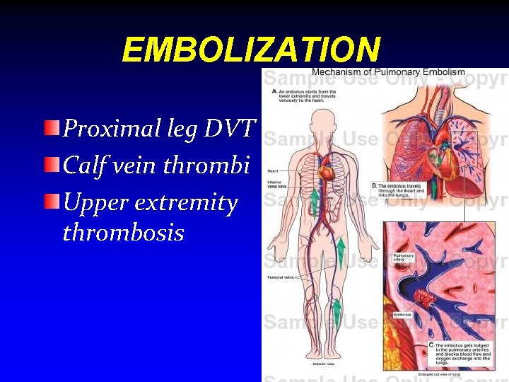 EMBOLIZATION Proximal leg DVT Calf vein thrombi Upper extremity thrombosis A&E(VINAYAKA) 