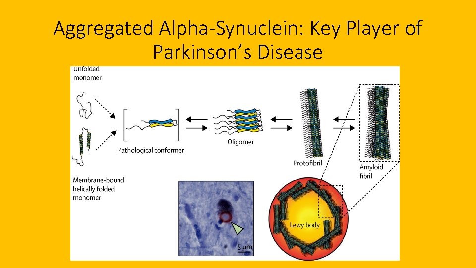 Aggregated Alpha-Synuclein: Key Player of Parkinson’s Disease 