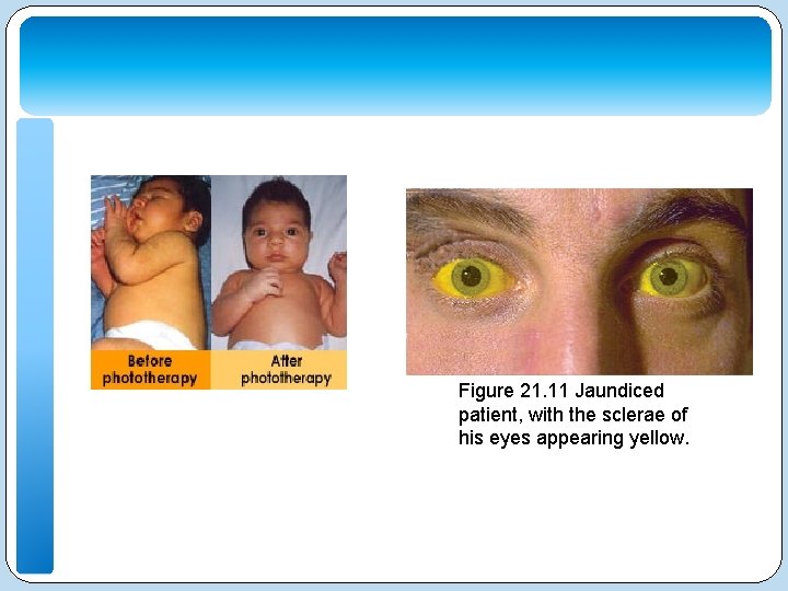 Figure 21. 11 Jaundiced patient, with the sclerae of his eyes appearing yellow. 