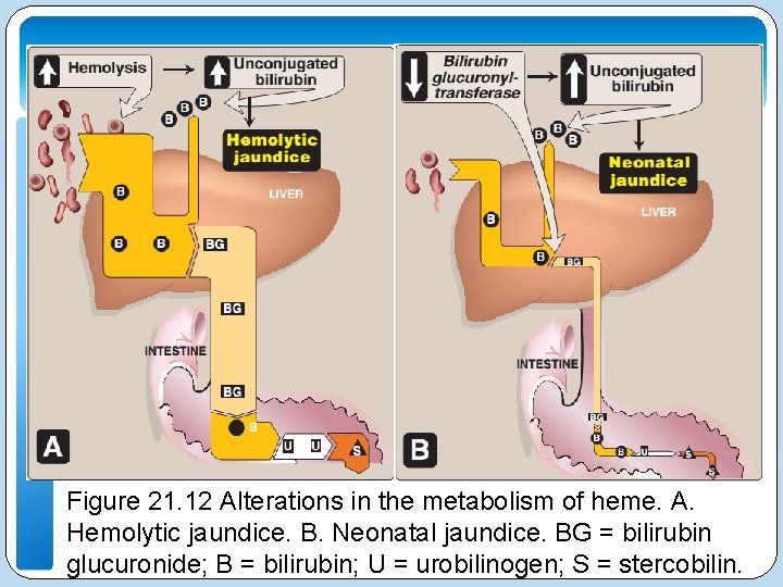 Figure 21. 12 Alterations in the metabolism of heme. A. Hemolytic jaundice. B. Neonatal