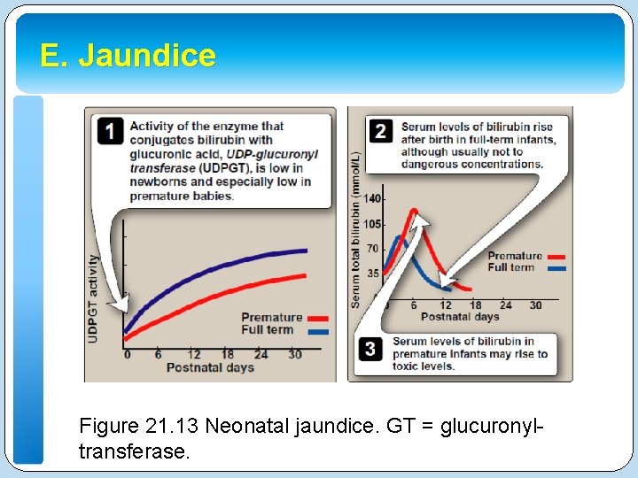 E. Jaundice Figure 21. 13 Neonatal jaundice. GT = glucuronyltransferase. 