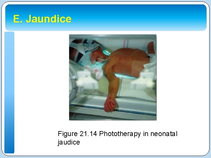 E. Jaundice Figure 21. 14 Phototherapy in neonatal jaudice 