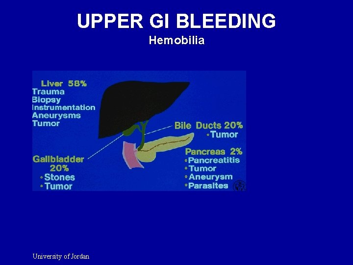 UPPER GI BLEEDING Hemobilia University of Jordan 