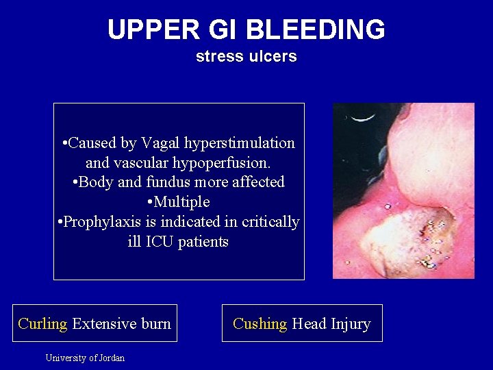 UPPER GI BLEEDING stress ulcers • Caused by Vagal hyperstimulation and vascular hypoperfusion. •