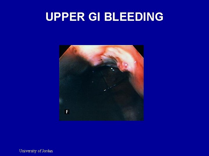 UPPER GI BLEEDING University of Jordan 