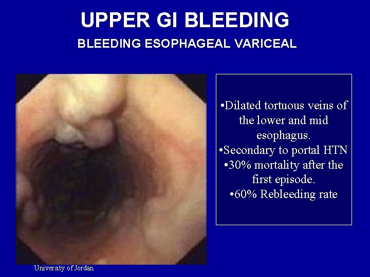UPPER GI BLEEDING ESOPHAGEAL VARICEAL • Dilated tortuous veins of the lower and mid