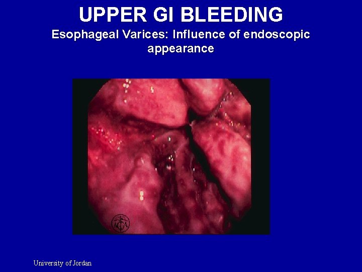 UPPER GI BLEEDING Esophageal Varices: Influence of endoscopic appearance University of Jordan 