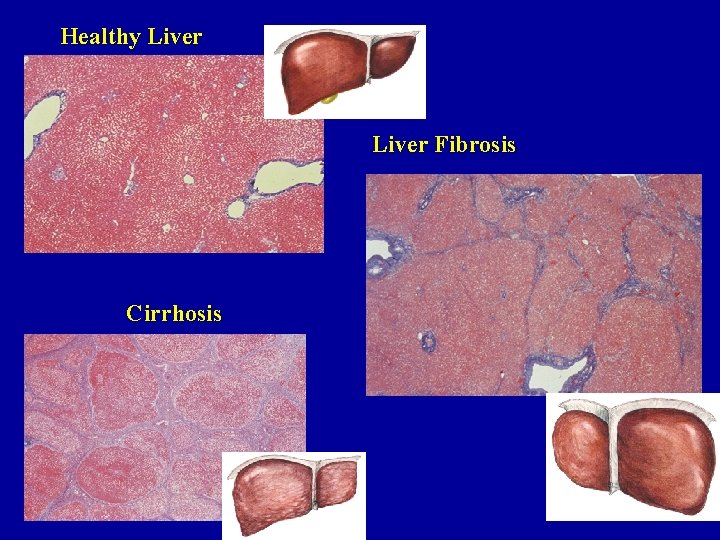 Healthy Liver Fibrosis Cirrhosis 