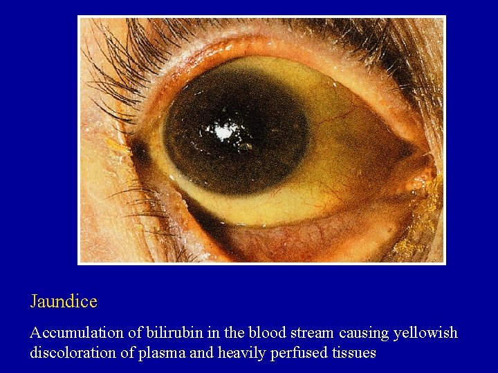 Jaundice Accumulation of bilirubin in the blood stream causing yellowish discoloration of plasma and