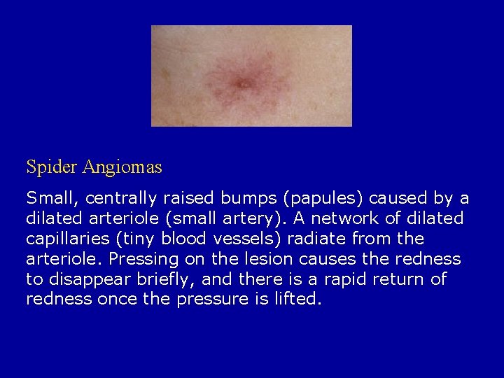 Spider Angiomas Small, centrally raised bumps (papules) caused by a dilated arteriole (small artery).