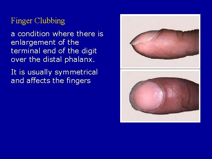 Finger Clubbing a condition where there is enlargement of the terminal end of the