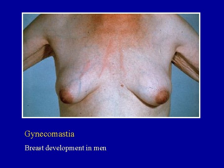 Gynecomastia Breast development in men 