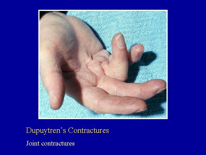 Dupuytren’s Contractures Joint contractures 