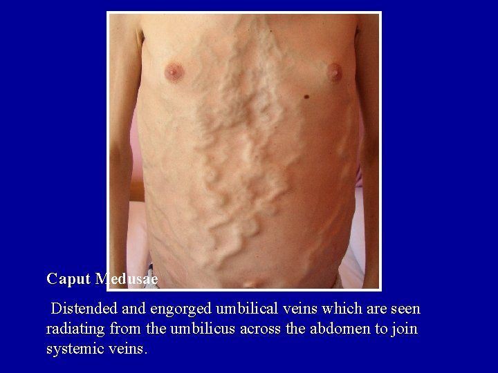 Caput Medusae Distended and engorged umbilical veins which are seen radiating from the umbilicus