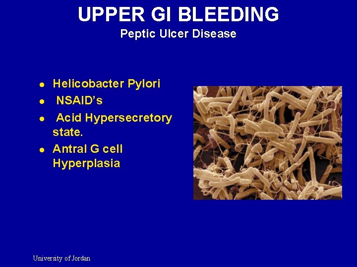 UPPER GI BLEEDING Peptic Ulcer Disease l l Helicobacter Pylori NSAID’s Acid Hypersecretory state.