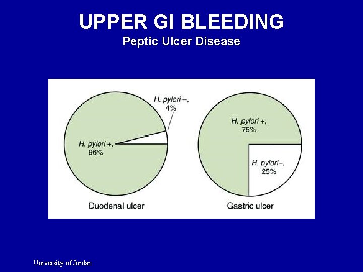 UPPER GI BLEEDING Peptic Ulcer Disease University of Jordan 